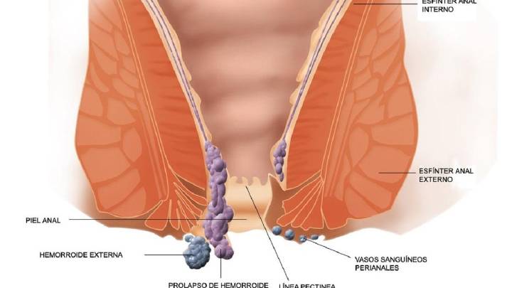 Cáncer de ano: el tumor que puede confundirse con hemorroides y afecta a mayores de 50 años