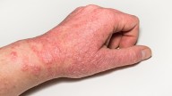 GLP-1s Cut CV Risks Tied to Type 2 Diabetes and AD