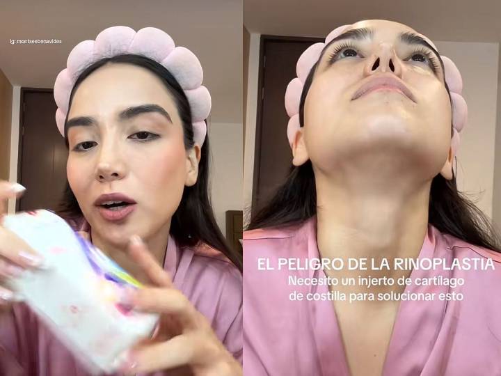 Le arruinaron la nariz: influencer revela secuelas de rinoplastia fallida