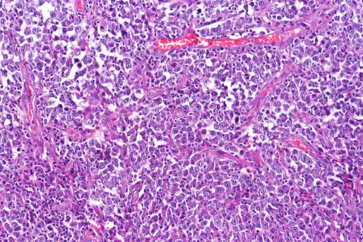 CRISPR Screen Identifies GATOR1 as Lymphoma Tumor Suppressor