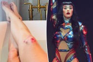 Katy Perry shows off brutally scraped knees she sustained during 'Lifetimes' tour