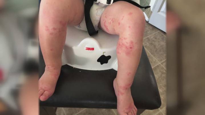 Northeast Ohio health officials say hand, foot and mouth disease is on the rise among teens