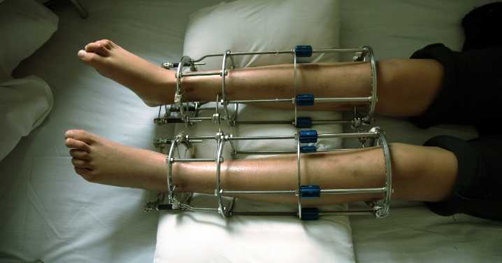 This Guy Paid $32K to Have His Legs Broken and Lengthened
