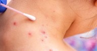 Kansas health officials say 2025 measles outbreak over