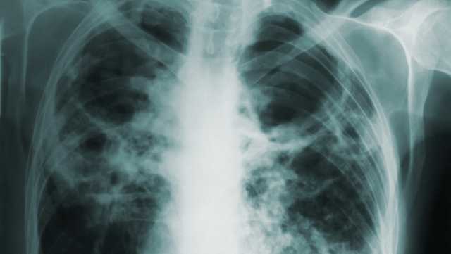 North Carolina: Another case of TB confirmed