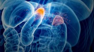 Classic Congenital Adrenal Hyperplasia: Understanding Treatment Options