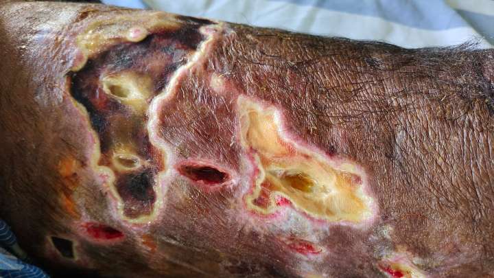 Alarma en EE.UU.: confirman primer caso humano de gusano que devora carne