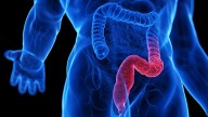 Cyclosporin: A Viable Option for Severe Ulcerative Colitis