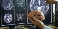 La terapia de conversación altera la estructura del cerebro, según muestran las resonancias magnéticas