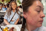 Exclusive | I’m vegan against my will after a developing a meat allergy overnight