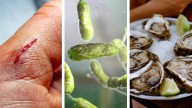 Aumenta en Florida casos por bacteria carnívora