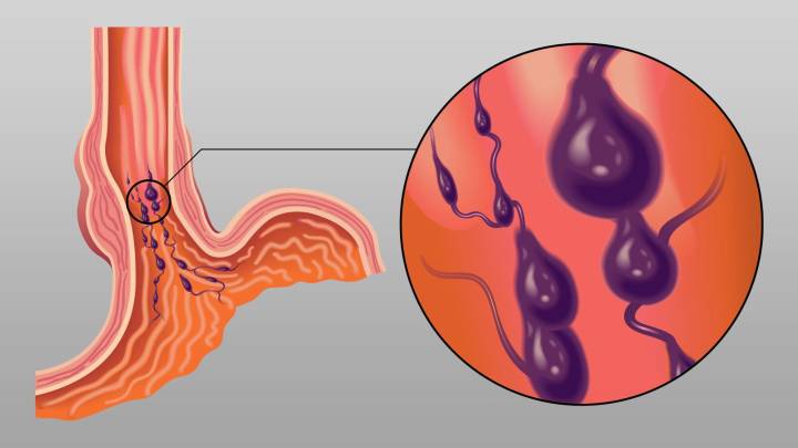 Prophylactic Antibiotics May Be of No Use in Cirrhosis With Upper GI Bleeding