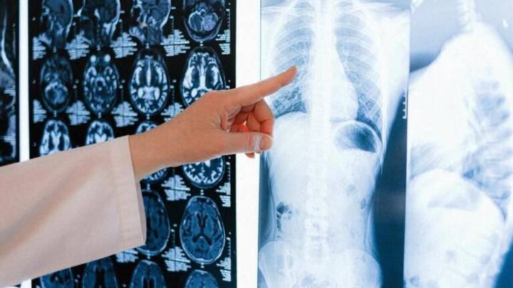 Descubren nueva vía para potenciar la inmunoterapia contra el cáncer de pulmón más agresivo
