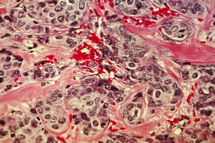 Un medicamento experimental logra reducir tumores metastásicos en seis pacientes y que desaparezca el cáncer en dos