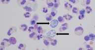 Patient contracts deadly amoeba after waterskiing in Lake of the Ozarks