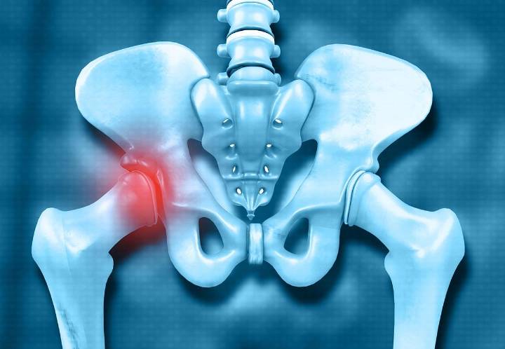 Most Adults Miss Symptoms of Hip Problems