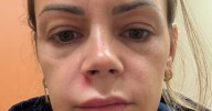 Mum rushed to hospital and unable to smile after popping pimple on face