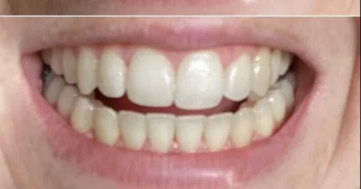 Dentist-backed 95p teeth whitening solution shoppers say 'works from first try'