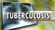 2 Klein Cain High School students diagnosed with active tuberculosis, parents notified