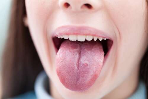 Ask the doctors: Adding zinc to diet may help geographic tongue