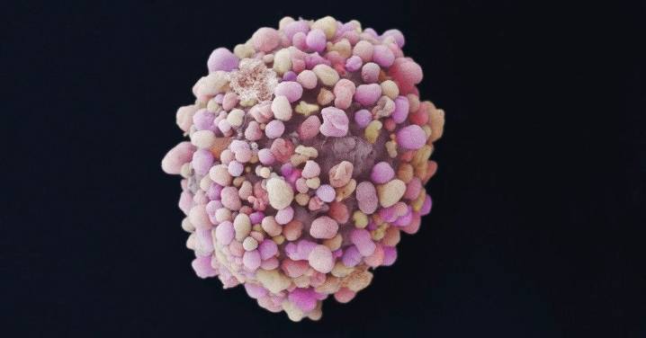 Una nueva terapia combinada reduce el riesgo de progresión del cáncer de mama triple negativo en un 52%
