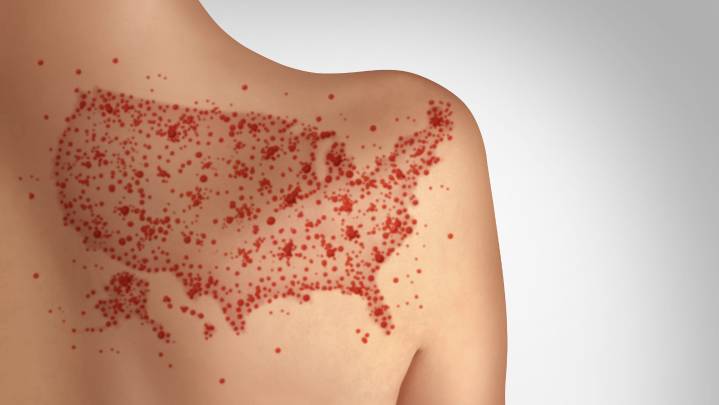 Do I need a measles vaccine? Three local vaccine clinics set