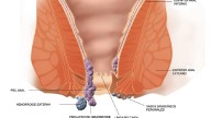 Cáncer de ano: el tumor que puede confundirse con hemorroides y afecta a mayores de 50 años