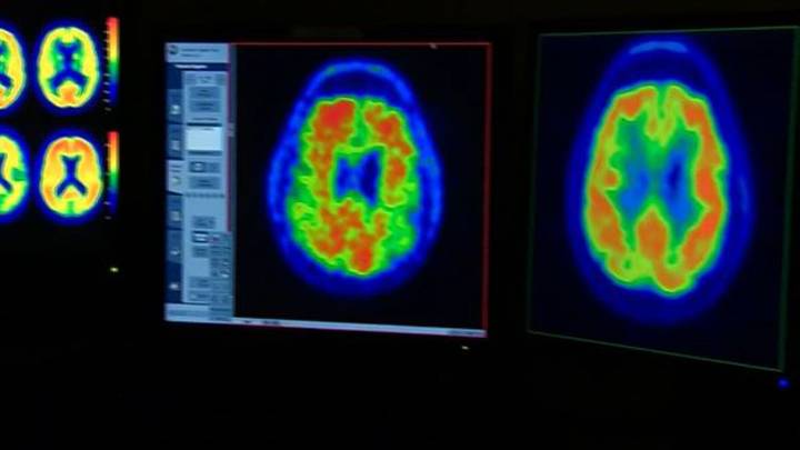 Brain breakthrough: Harvard Medical School study shows lithium may reduce Alzheimer’s risk