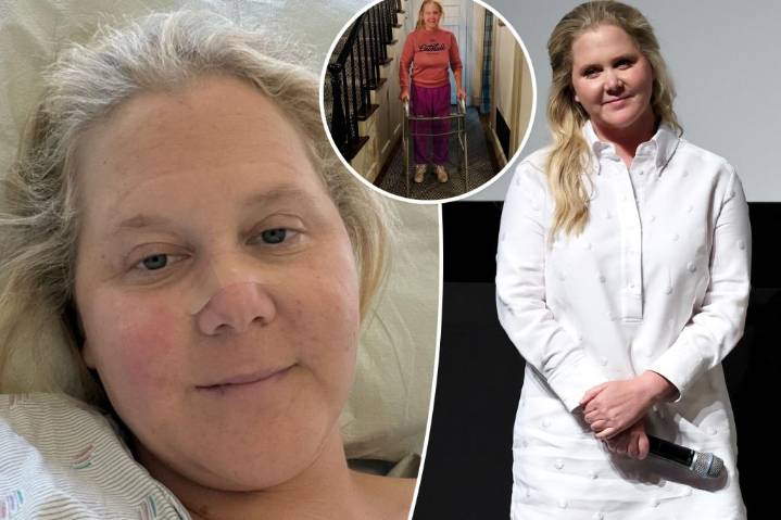 Amy Schumer shares photo of herself using a walker after spinal surgery
