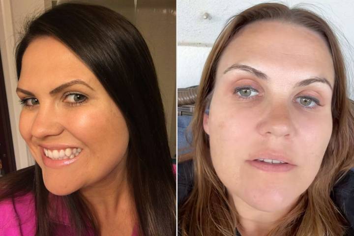 Woman Warns Others Against Tattooed Eyeliner After 10