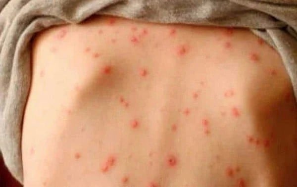 Supera Chihuahua los 4 mil casos de sarampión