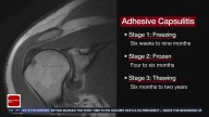 What is frozen shoulder, and how is it treated?