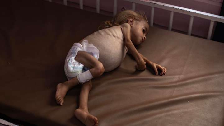 Al Menos 100 Niños Murieron de Hambre en Gaza Desde Inicio de la Guerra 