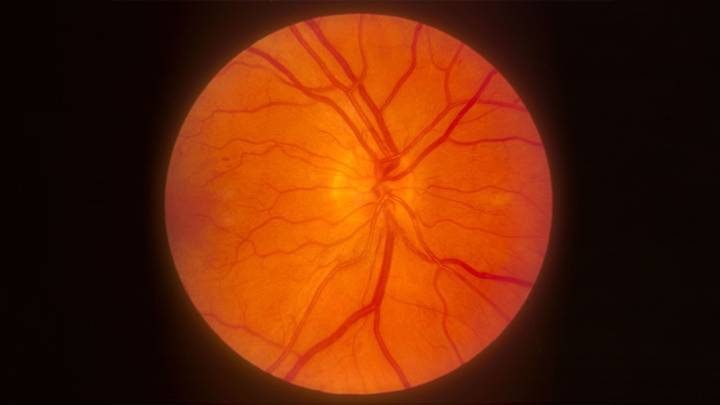 Popular Diabetes Drugs Linked to Small Risk of Retinal, Optic Nerve Disorders