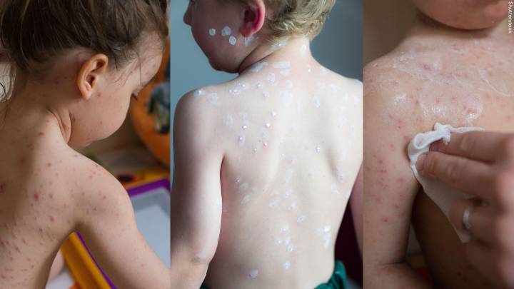 NHS to give free Chickenpox vaccine to children