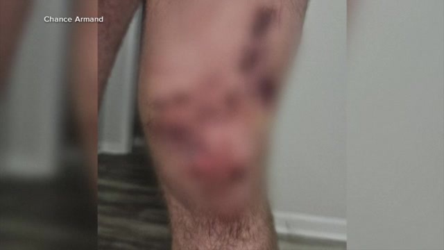 Man bitten by bull shark while spearfishing off Pensacola shares survival story 