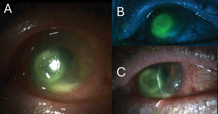 Contact lens wearer experiences persistent decreased vision, ocular pain