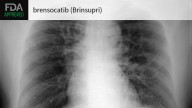 Serious Chronic Lung Disease Gets First FDA