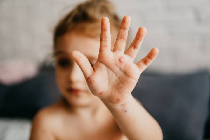 Westfield Health Bulletin: Rashes and sores are more common than you think