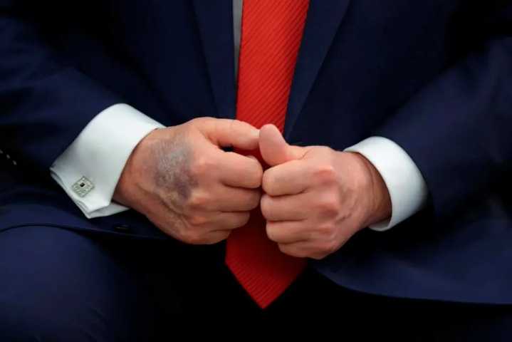 Trump fue visto nuevamente con una contusión en la mano derecha: todo lo que sabemos sobre su condición