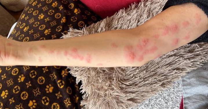 Woman's urgent warning after picking blackberries left her with horrific burns