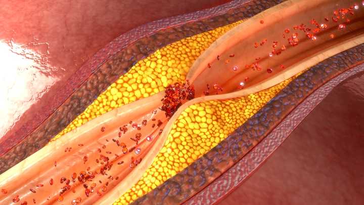 Una técnica española de imagen usada en cáncer podría mejorar el abordaje de la aterosclerosis
