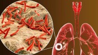 Tuberculosis en Guanajuato: Repuntan los casos en más del 27% en 2025
