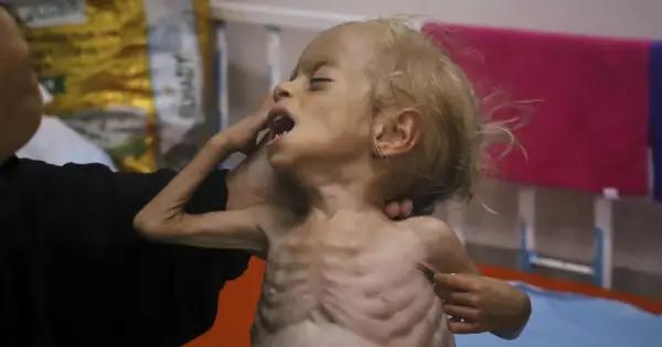 Crisis de desnutrición en Gaza: niños mueren por falta de alimentos