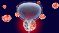 Don’t Reclassify Grade Group 1 Prostate Cancer: New Data