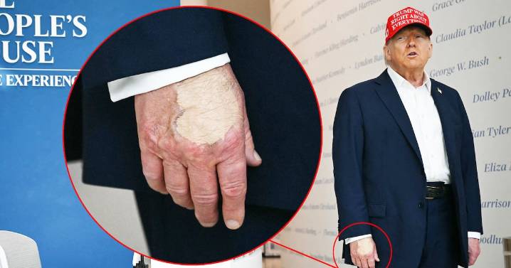 Trump, 79, Smears Right Hand In Makeup Amid Cankles Cover