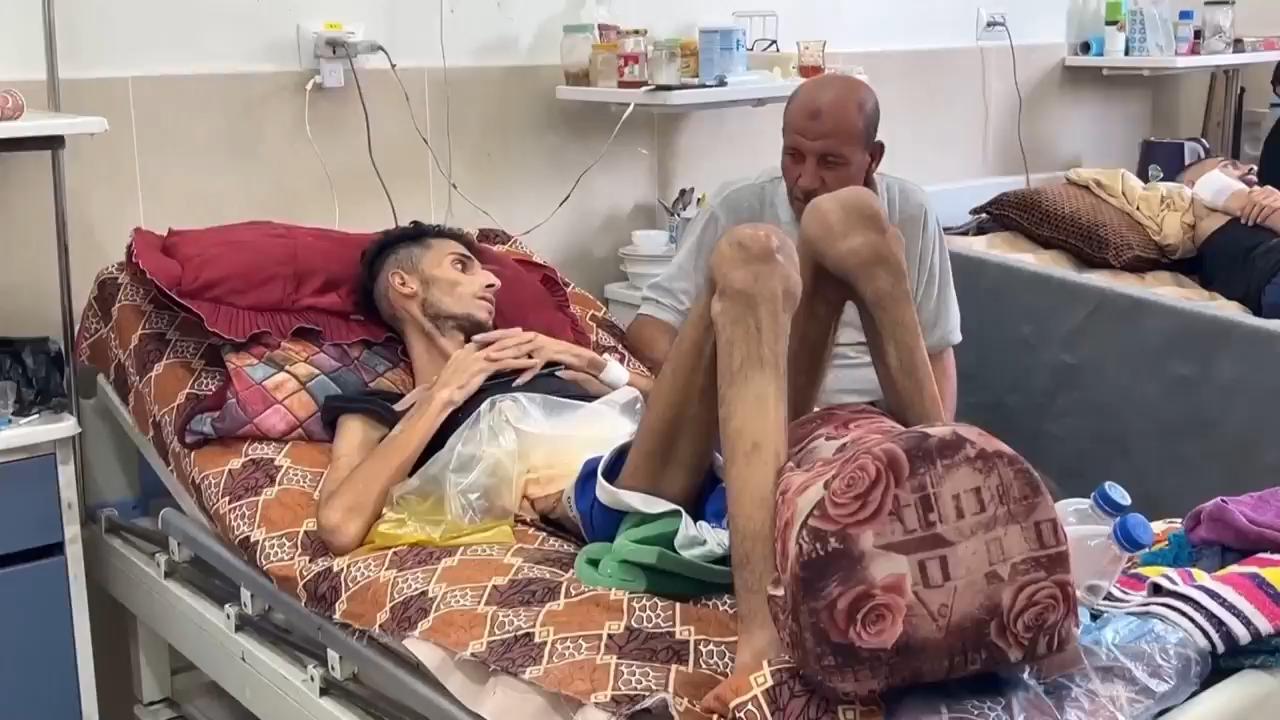 Doctors in Gaza say evidence of malnutrition is right in front of them