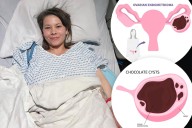 What is a chocolate cyst? Bindi Irwin has growth, lensions removed