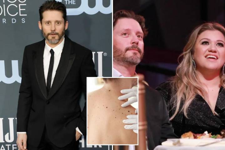 All about melanoma as Kelly Clarkson's ex-husband Brandon Blackstock dies at 48