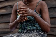 Why one doctor says we’re ‘walking blind’ in the mpox emergency